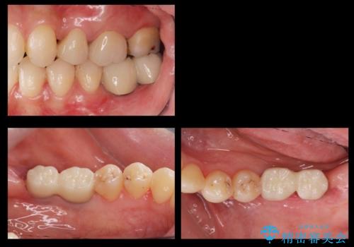奥歯のインプラントの症例 治療後