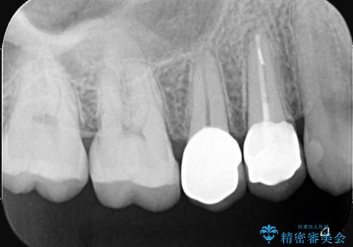 【セラミッククラウン】銀の詰め物していた歯が割れたの治療後