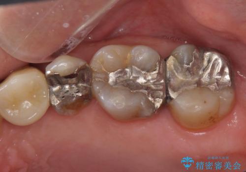 左上の歯が欠けた。の治療前