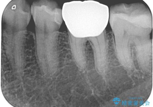 【セラミックインレー・フルジルコニアクラウン】2本の銀歯の下が虫歯にの治療後