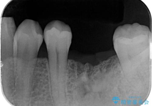 大臼歯の欠損 インプラント治療の治療前