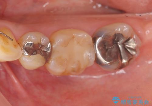 銀歯の周囲が黒く変色 精密セラミック治療の症例 治療前