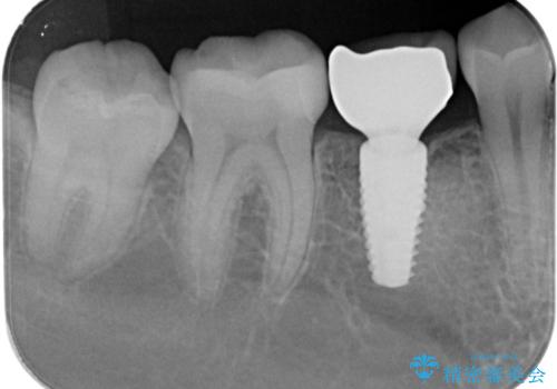 インプラント治療の治療後