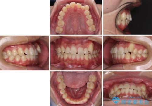 目立つ八重歯を非抜歯矯正で整える 目立たないワイヤー矯正の治療前