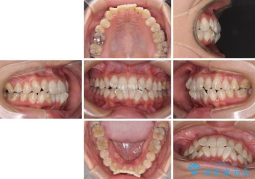 全く目立たないワイヤー矯正 上下裏側矯正の治療前
