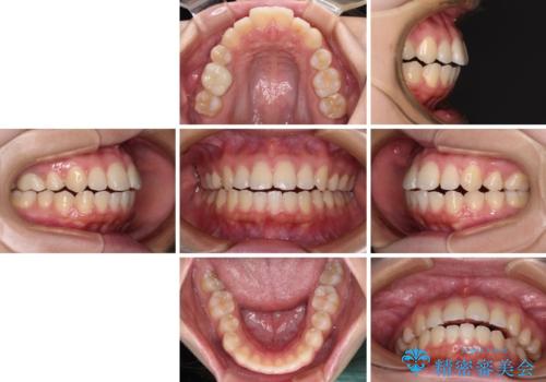 再矯正 開咬に後戻りした歯列をインビザラインで改善の治療前