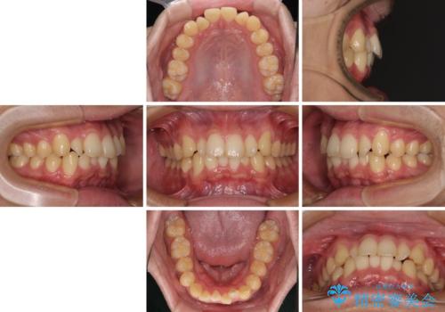 前歯のデコボコを治したい　ワイヤー装置での非抜歯矯正の治療前
