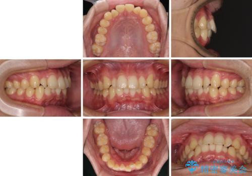 前歯のデコボコを治したい ワイヤー装置での非抜歯矯正の治療前
