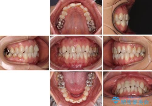 デコボコと銀歯　矯正治療とセラミック治療で綺麗な口元にの治療前