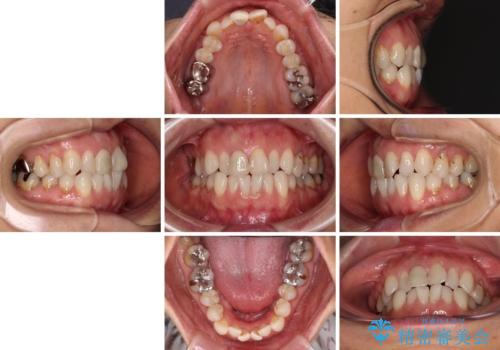 デコボコと銀歯 矯正治療とセラミック治療で綺麗な口元にの治療前