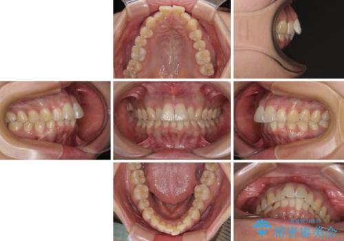 前に飛び出して目立っている前歯を整える　インビザライン矯正治療の治療前