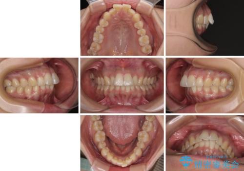 前に飛び出して目立っている前歯を整える インビザライン矯正治療の治療前