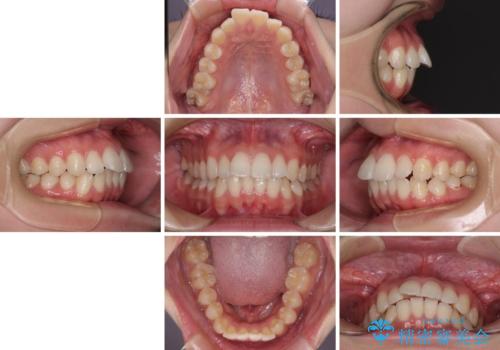 【モニター】前に傾斜した前歯　インビザラインでスッキリとした口元にの治療前