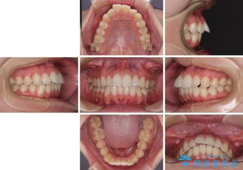 【モニター】前に傾斜した前歯 インビザラインでスッキリとした口元にの治療前