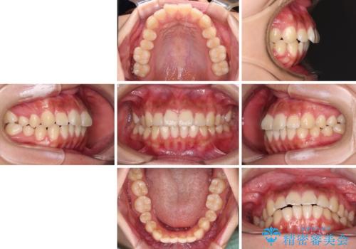 飛べ出ている出っ歯を治したい　目立たない装置での抜歯矯正治療の治療前