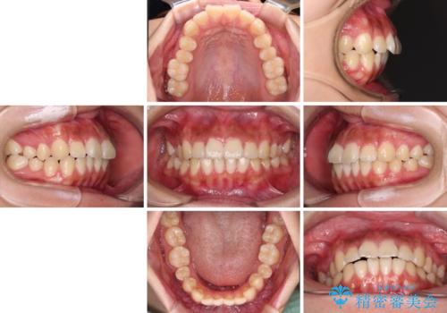 飛び出ている出っ歯を治したい 目立たない装置での抜歯矯正治療の治療前