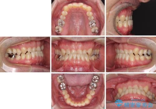 受け口を治す　ワイヤー装置での矯正治療の治療前