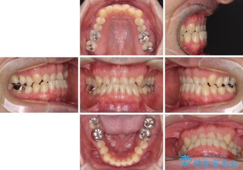 受け口を治す ワイヤー装置での矯正治療の治療前
