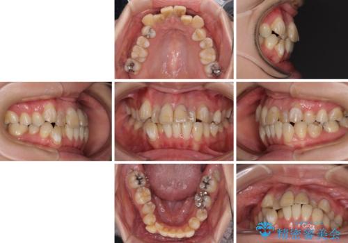気になる八重歯と変色した前歯　抜歯矯正とセラミッククラウン治療の治療前