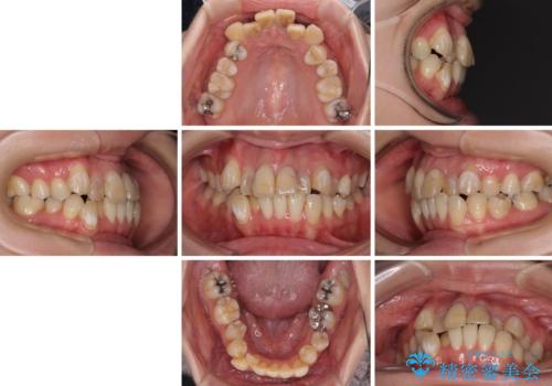 気になる八重歯と変色した前歯 抜歯矯正とセラミッククラウン治療の治療前