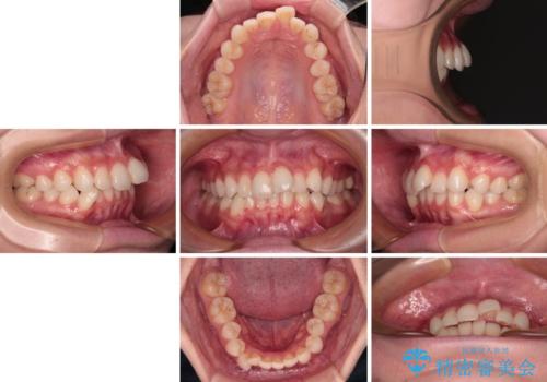 前歯のデコボコを治したい 目立たないワイヤー装置での矯正治療の治療前