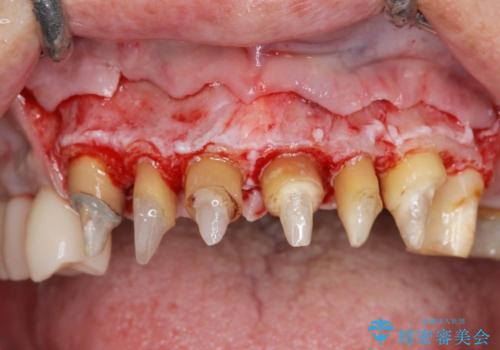 [ 歯ぐきから出血をする ]　歯周外科を伴うセラミックやりかえ治療の治療前