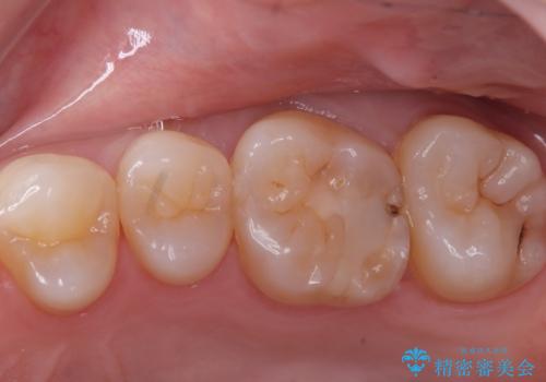 【セラミックインレー】歯に穴が空いているの治療前