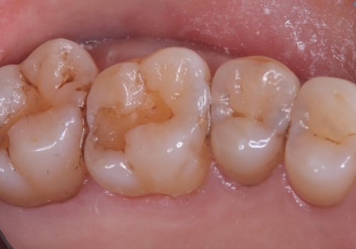 【セラミックインレー】海外に行く前に虫歯治療してほしいの治療前