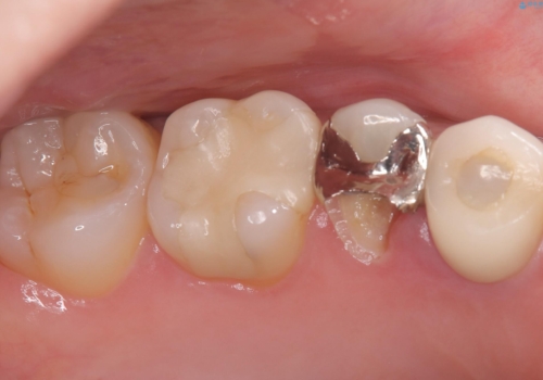 【セラミッククラウン】銀の詰め物していた歯が割れた