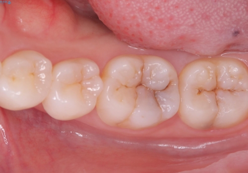 【セラミックインレー】噛む面が青白い気がするの治療前