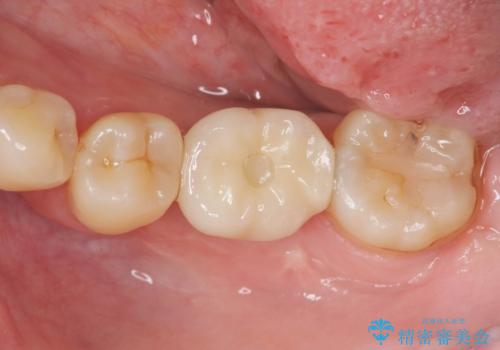 大臼歯の欠損 インプラント治療の治療後