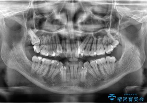 【ワイヤー矯正】八重歯 歯のでこぼこを治したい!の治療前