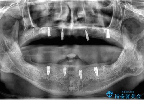 全体的に治したい。インプラントオーバーデンチャーによる治療。の治療後
