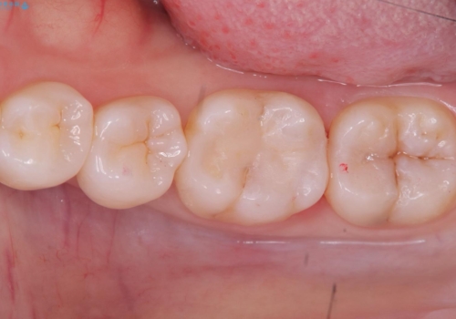 【セラミックインレー】噛む面が青白い気がするの治療後