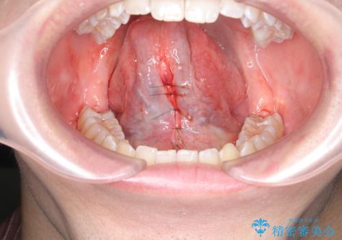 「サ行」が発音しづらい 舌小帯形成術で改善の治療中