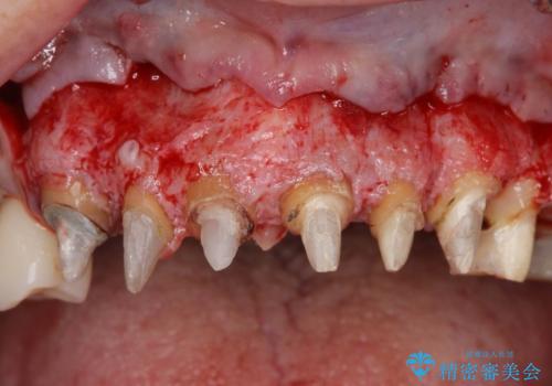 [ 歯ぐきから出血をする ]　歯周外科を伴うセラミックやりかえ治療の治療前