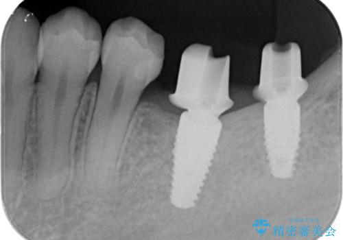 奥歯のインプラントの治療中