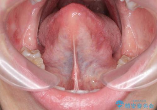 「サ行」が発音しづらい 舌小帯形成術で改善の治療前