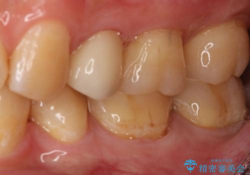 奥歯の保険材料を自費でやり直したいの治療前