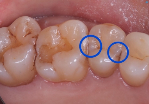 【セラミックインレー】海外に行く前に虫歯治療してほしいの治療前