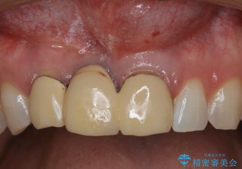 前歯ブリッジのやり変え希望 オールセラミッククラウンの治療前