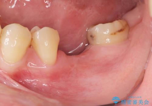 大臼歯の欠損 インプラント治療の症例 治療前