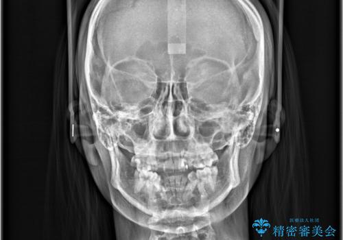 【ワイヤー矯正】八重歯 歯のでこぼこを治したい!の治療前