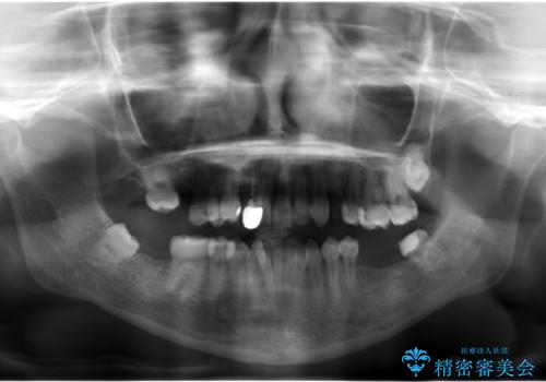あきらめないで!!虫歯でボロボロでも大丈夫! 非抜歯矯正と虫歯、インプラント治療で見違える歯並びに。の治療前
