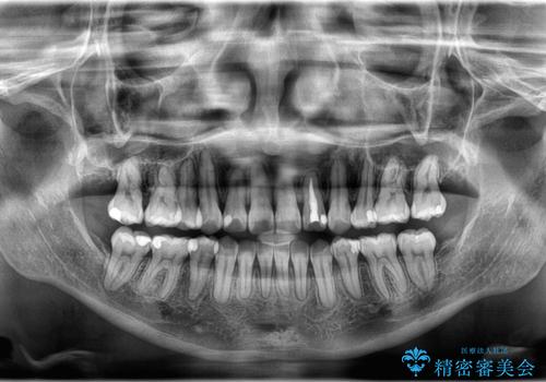 【ワイヤー矯正】八重歯 歯のでこぼこを治したい!の治療後