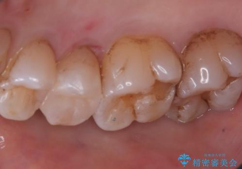 【セラミックインレー】海外に行く前に虫歯治療してほしいの治療後