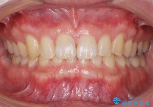 ディープバイトのマウスピース矯正の症例 治療後