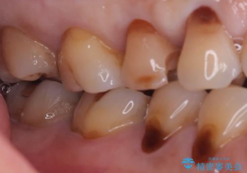 【セラミックインレー】海外に行く前に虫歯治療してほしいの治療中