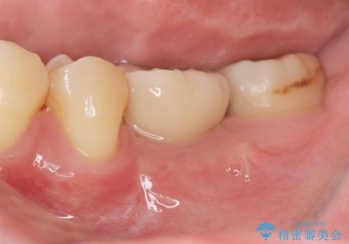 大臼歯の欠損 インプラント治療の症例 治療後