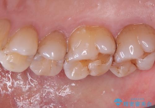 【セラミックインレー】海外に行く前に虫歯治療してほしいの治療前